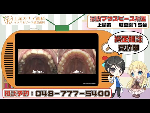 上尾市の歯医者が紹介する最新マウスピース矯正・パート348 | 上尾カナデ歯科・インビザライン