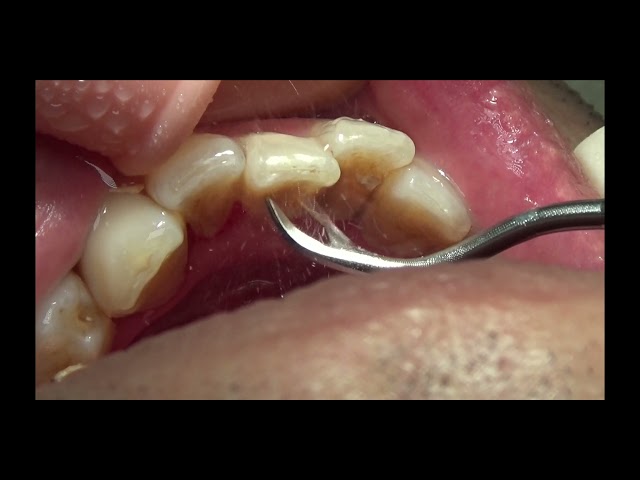 上尾の歯医者の歯周病・口臭予防の歯石取り動画 R4年2月25日 |  健康・口腔ケア